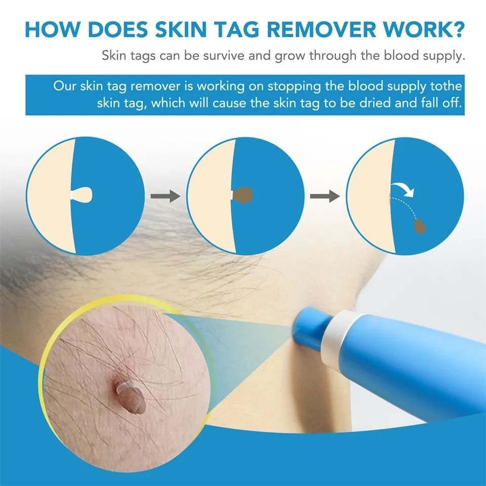 Aid Plus™ Skin Tag Removal Pen – Precision Spot Treatment for Fast, Painless Removal - Zalunas