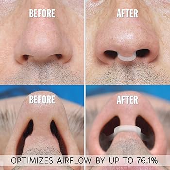 ZALUNAS Serene – Premium Anti - Snore Mouthpiece + Free Premium Nasal Dilator - Zalunas